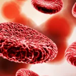 کم خونی شدید در بانوان